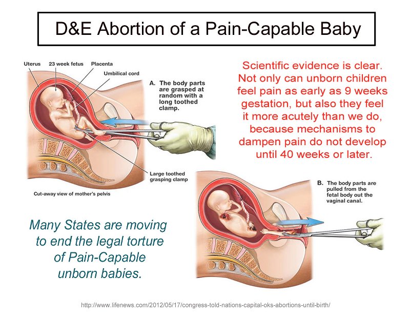 D&E Abortion of a Pain-Capable Baby